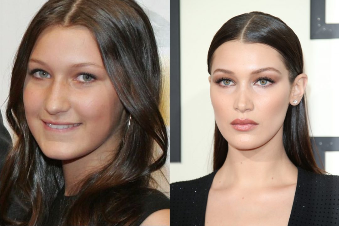 Bella Hadid prima e dopo aver fatto ricorso alla chirurgia estetica